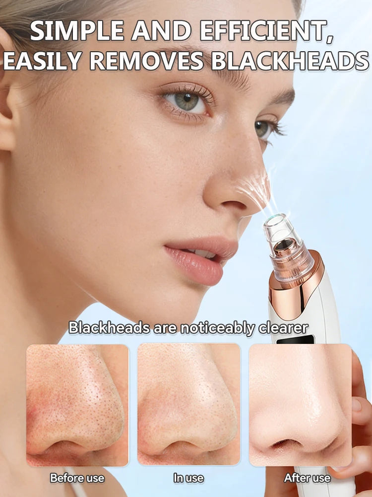 Radiance Pro Blackhead Remover