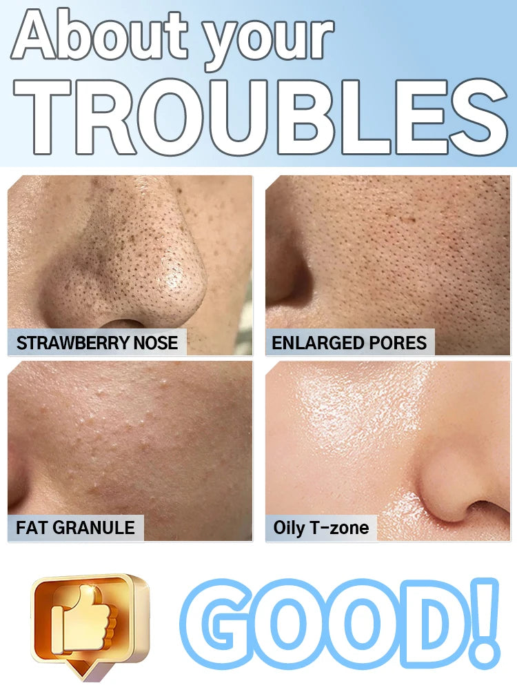 Radiance Pro Blackhead Remover